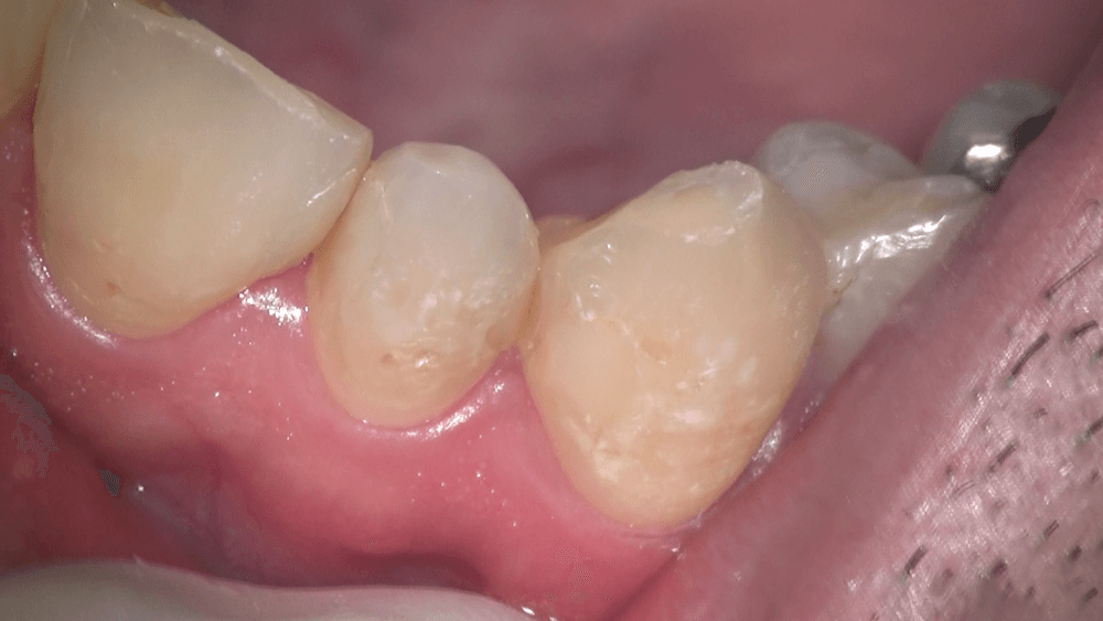 歯 の 表面 ザラザラ