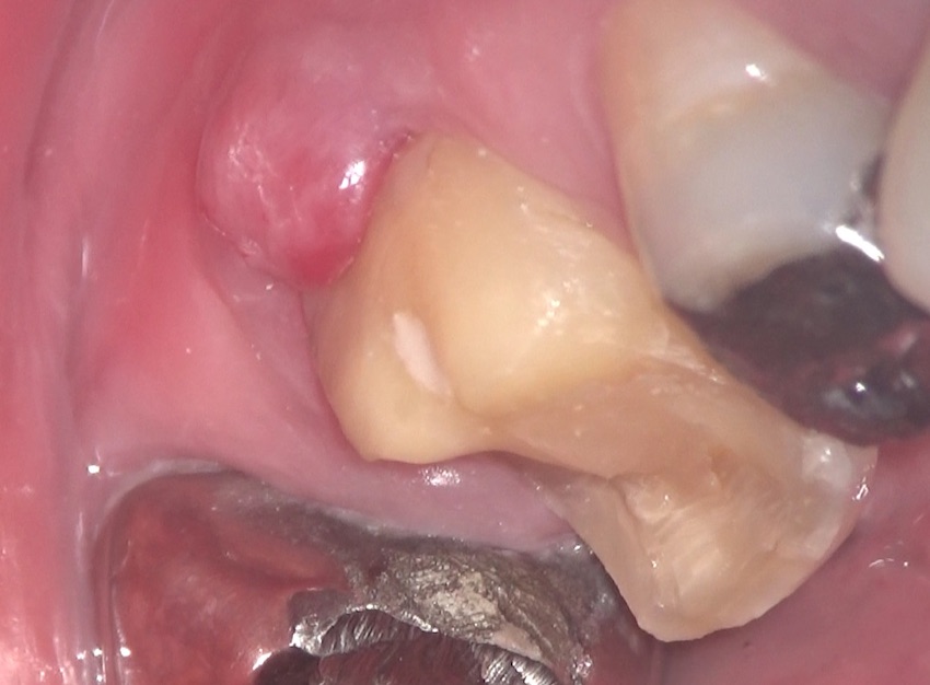 腫れ 歯茎 の 歯茎がぷっくり…でも「痛くないから大丈夫」はとても危険！