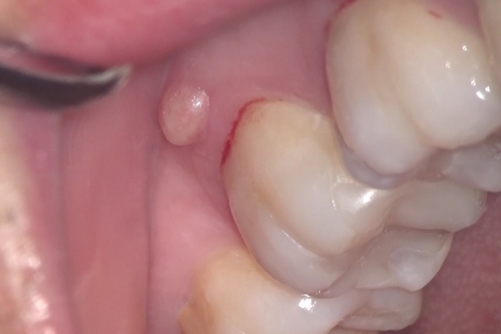 腫れ 歯茎 の 奥歯の歯茎が腫れる6つの原因と対処法！ぶよぶよになる前に行うケアも