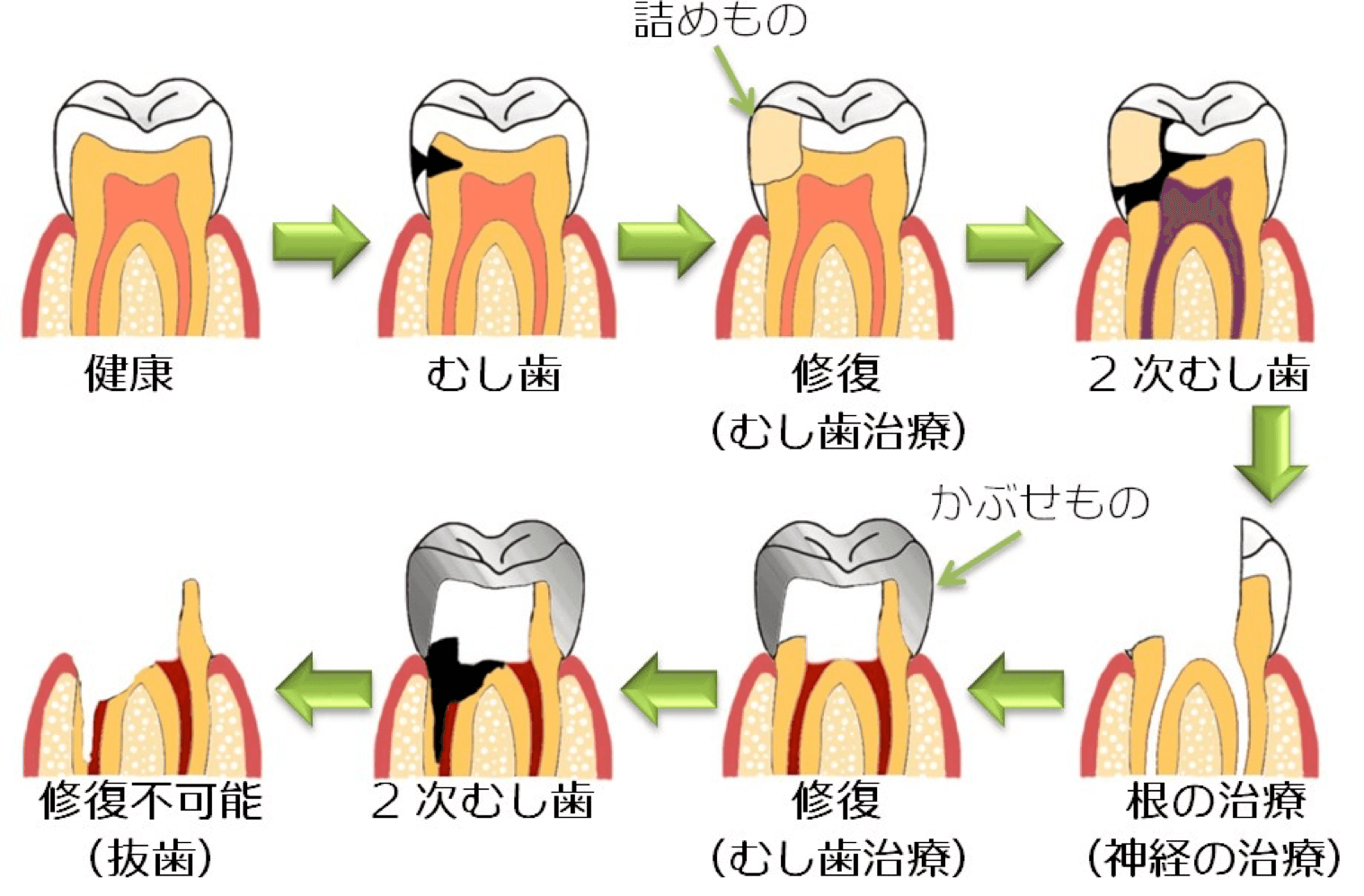 歯 と 歯 の 間 虫歯 治療