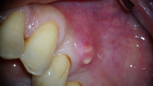 歯茎 の 白い 腫れ