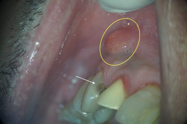 歯茎の腫れを自分で潰して膿を出していいですか 東京都調布市の歯医者 歯科 柴崎駅5分の柳沢歯科医院