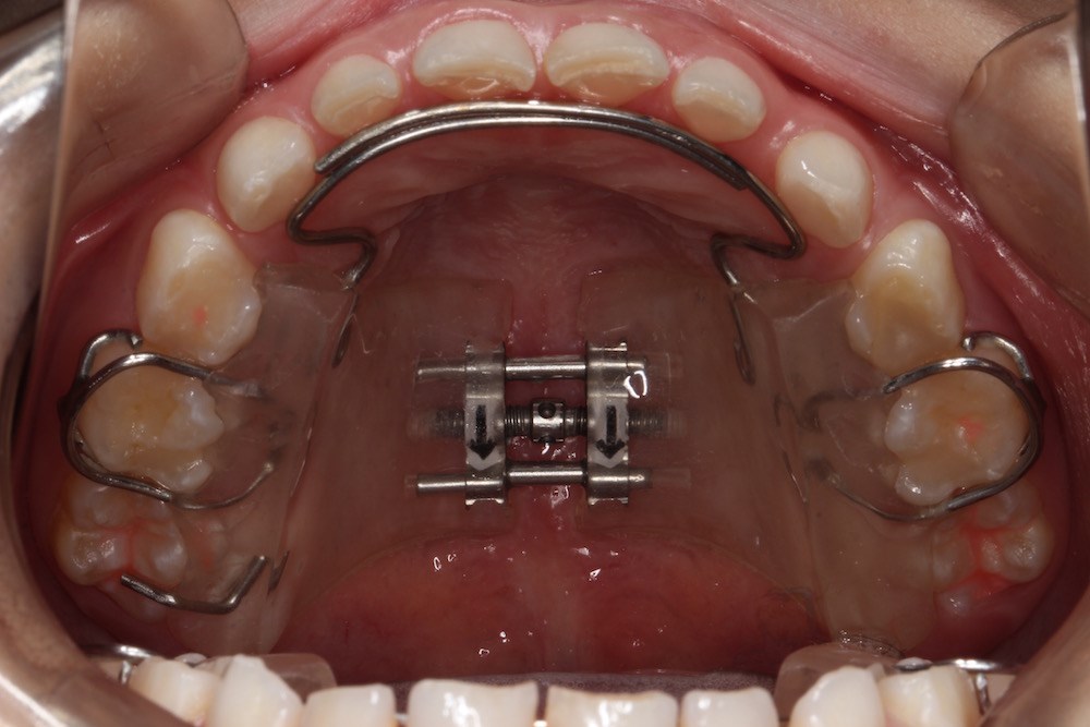 上顎 拡大 装置