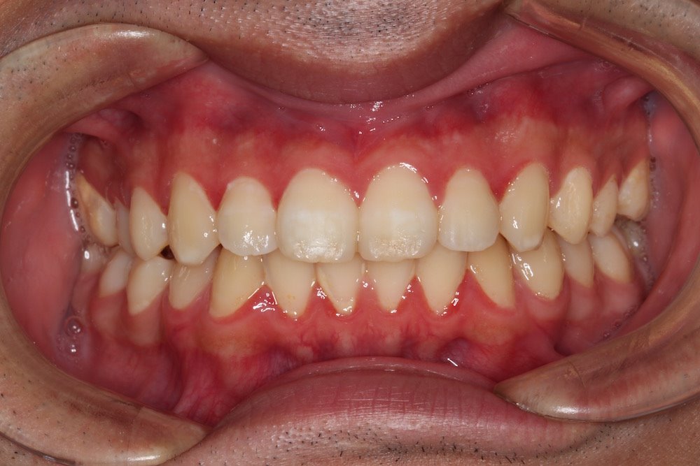 歯茎 の 腫れ 歯肉 炎