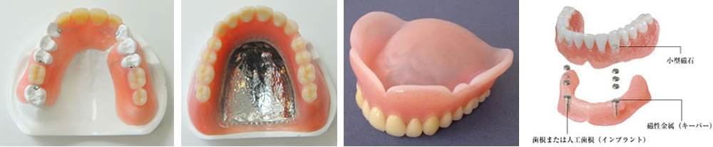 入れ歯の選択肢