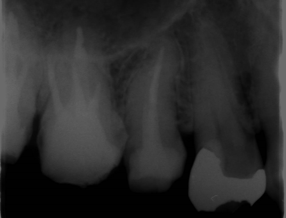 右上５　S字状根を持つ歯の再根管治療の症例