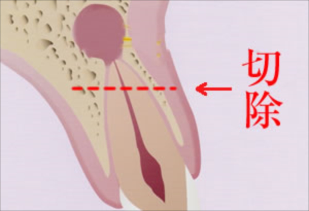 歯根端切除術