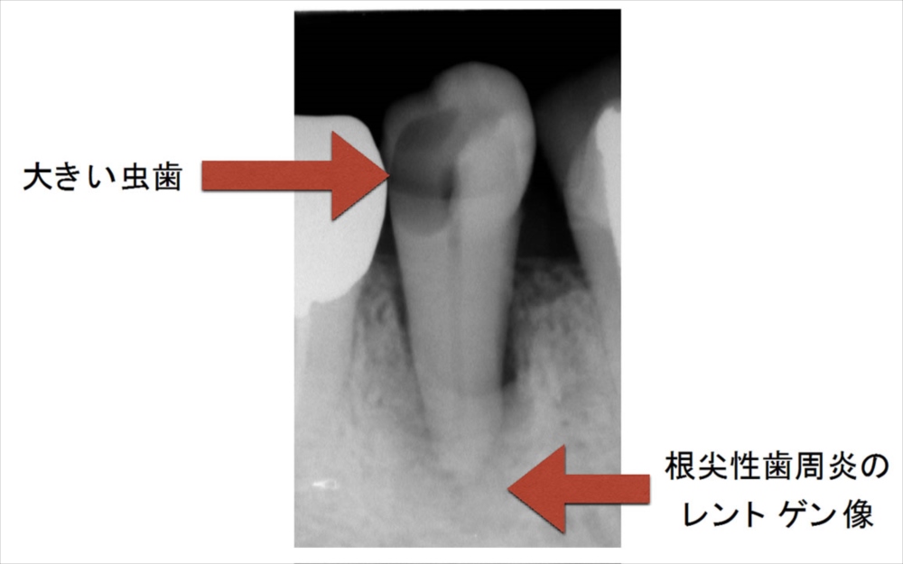 根尖性歯周炎併発の虫歯のレントゲン