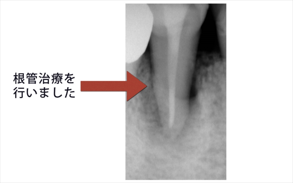 根管治療直後