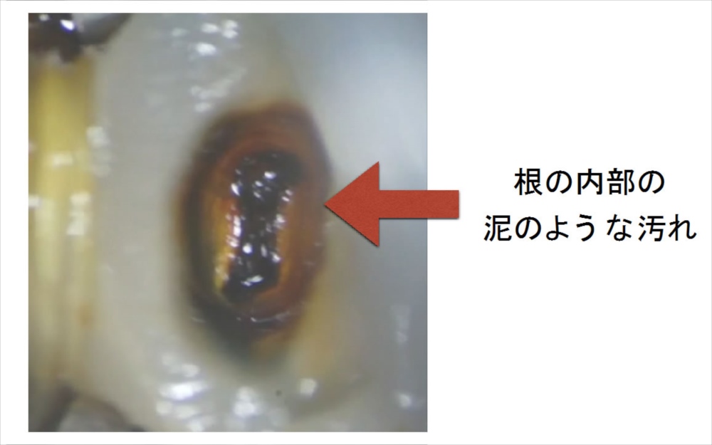 根管治療開始