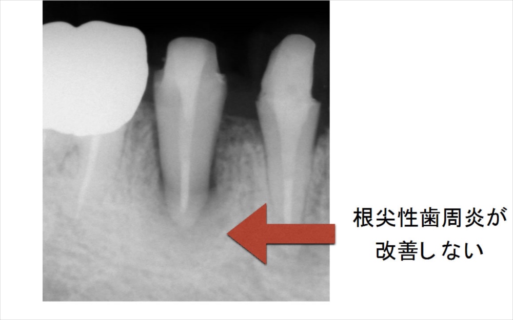 根管治療後２ヶ月のレントゲン