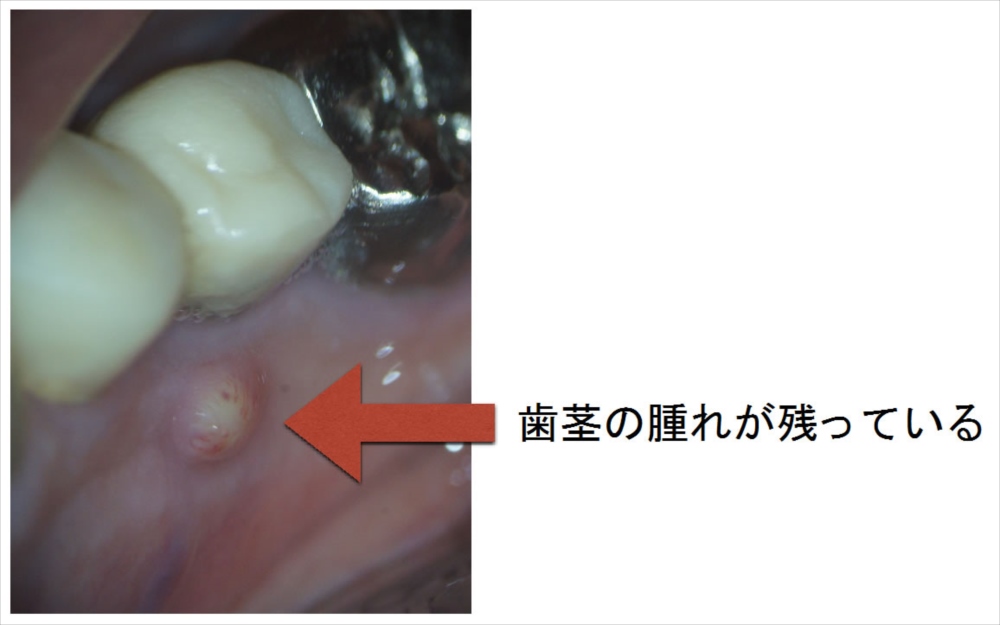 歯ぐきに腫れ症状