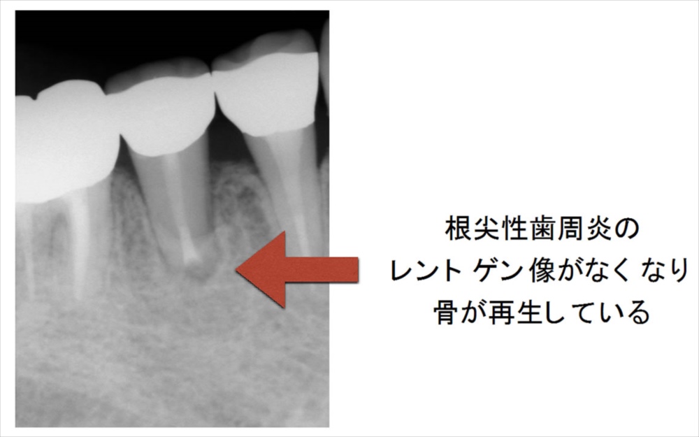 歯根端切除術後１年