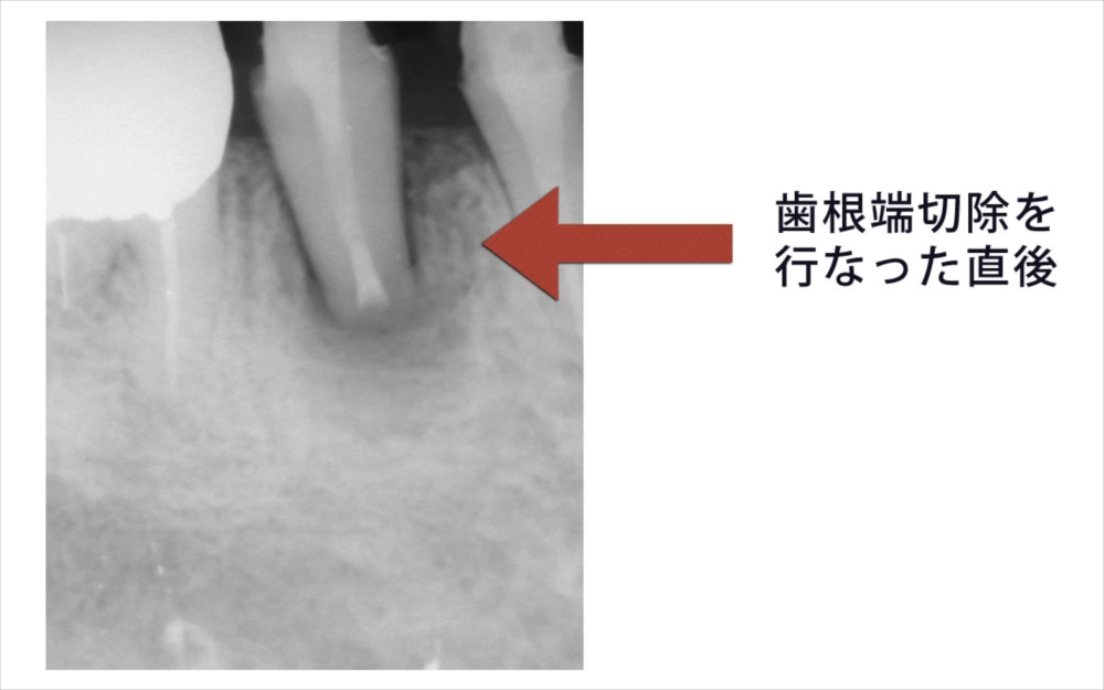 歯根端切除直後のレントゲン
